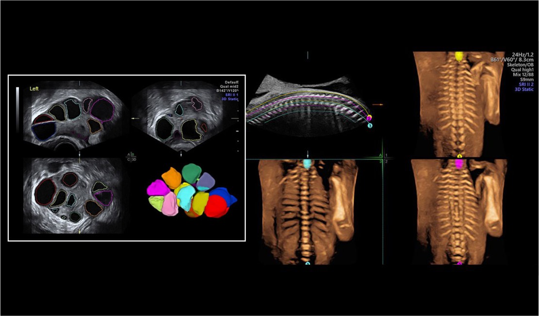 3-D Ultrasound