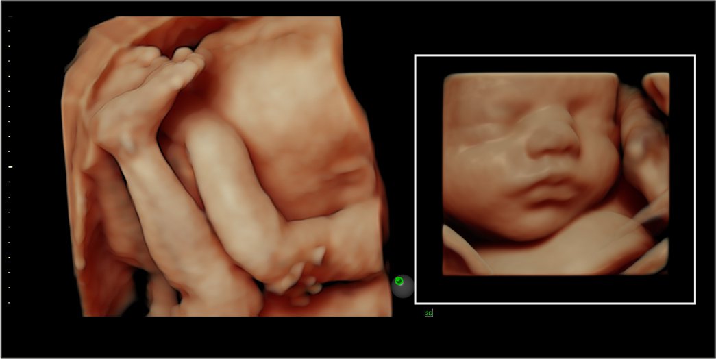 4-D Ultrasound