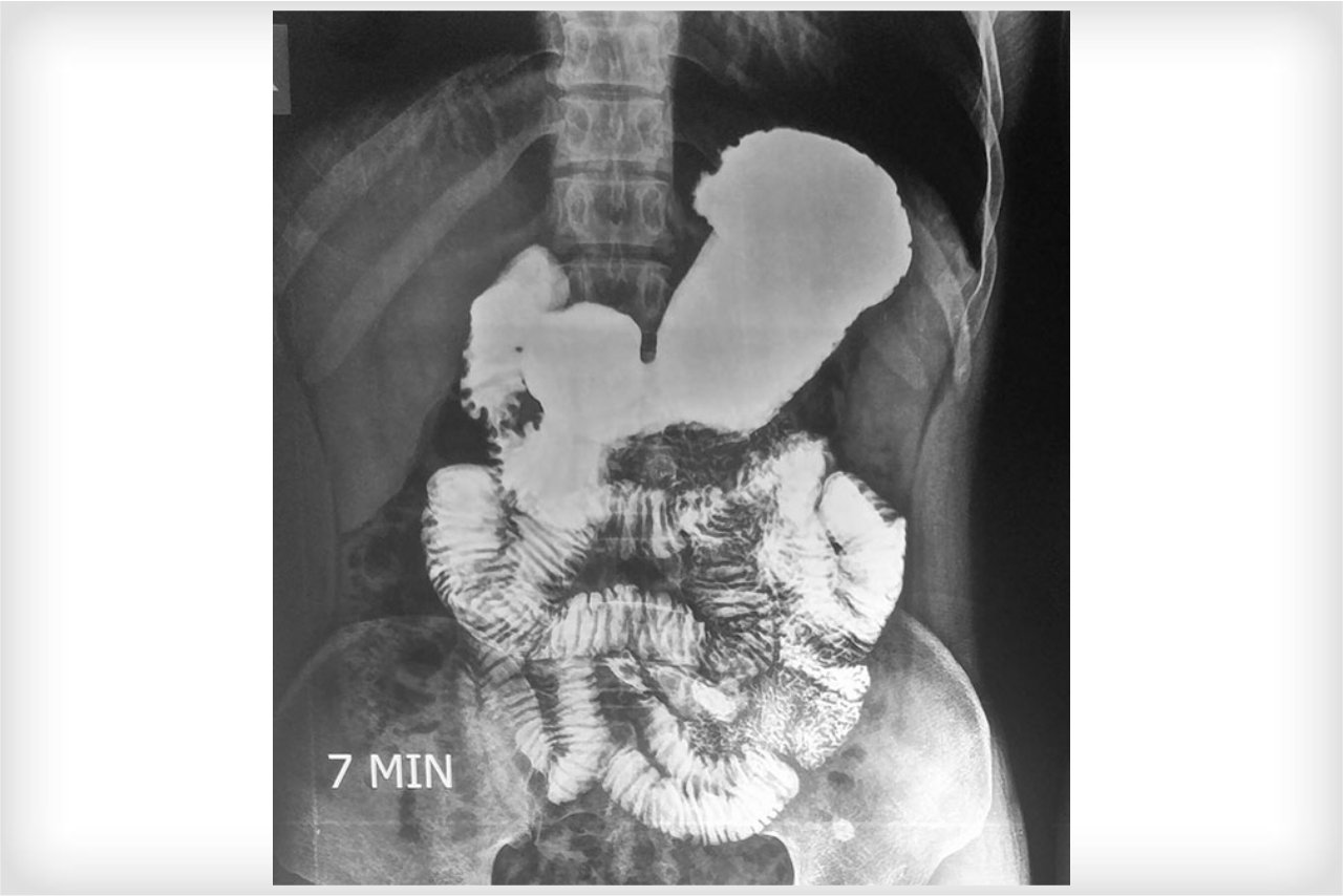 Barium Meal