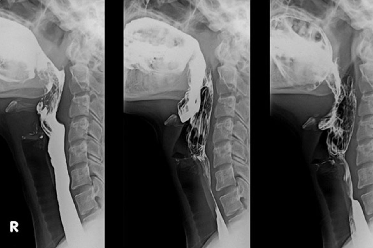 Barium Swallow