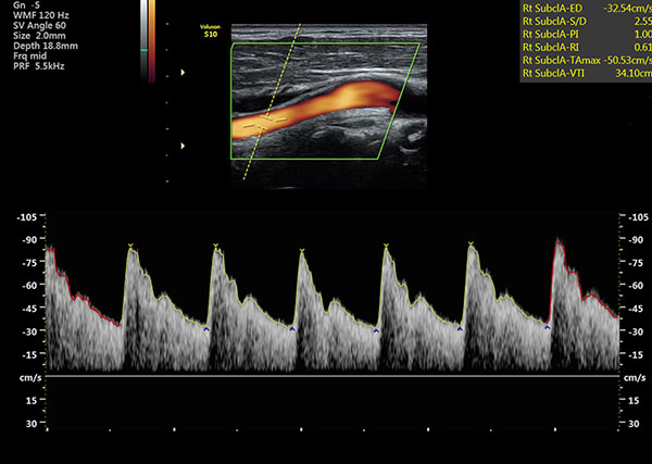 WHAT IS A DOPPLER VASCULAR ULTRASOUND