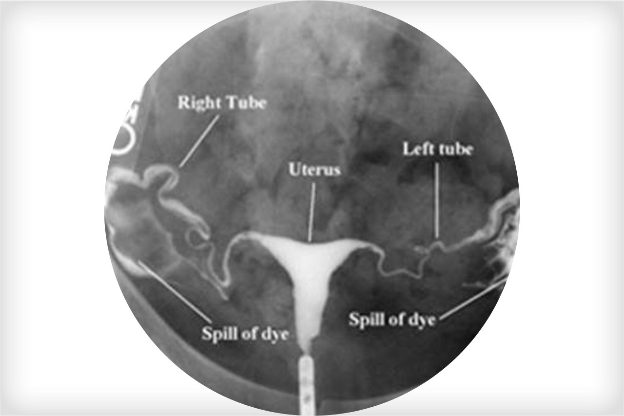 Hysterosalpingogram