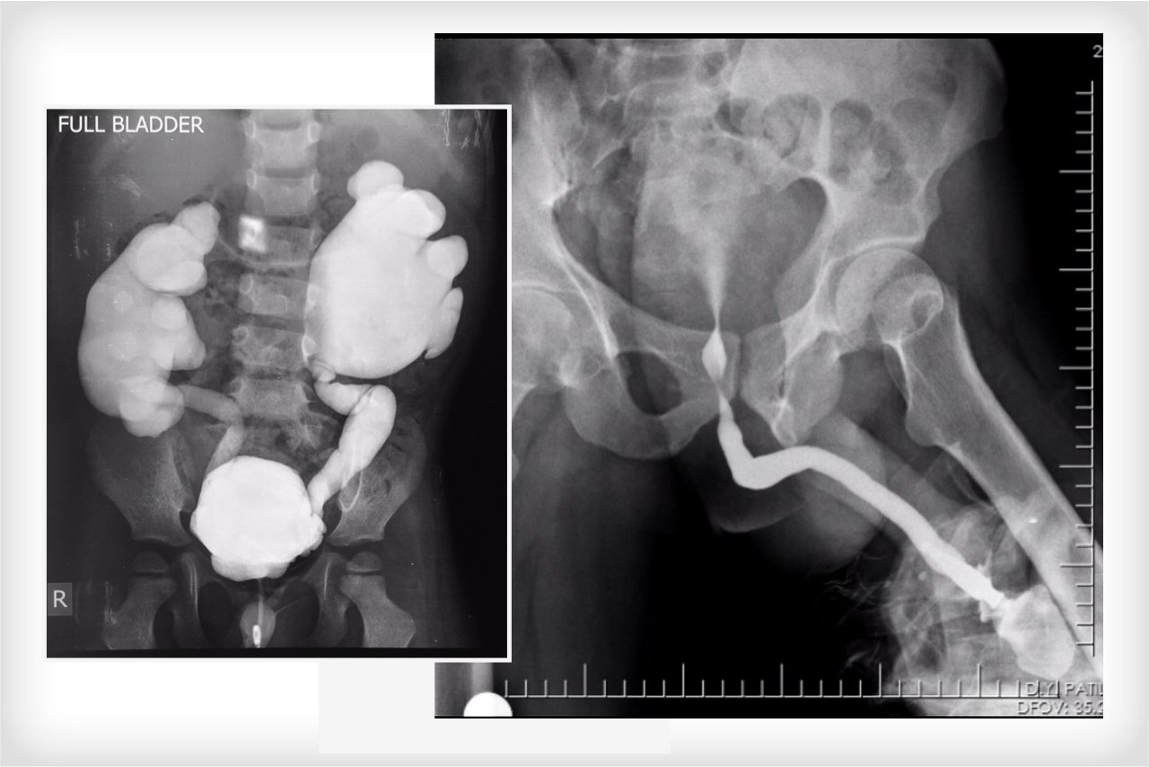 Micturating Urethrography