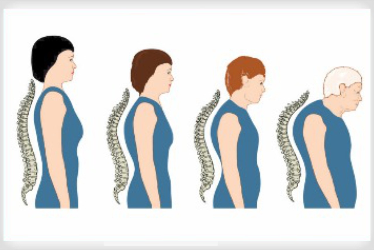 Osteoporosis