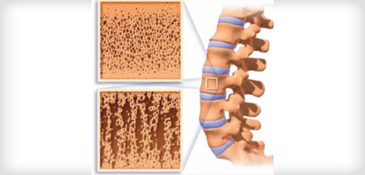 Osteoporosis Symptoms