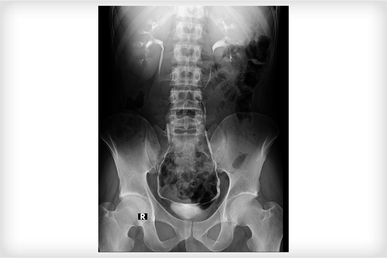 Intravenous pyelography - IVU Intravenous Pyelogram